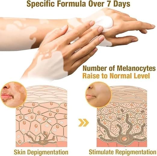 Bee Venom Vitiligo Treatment Herbal Skin Pigment Repair Cream