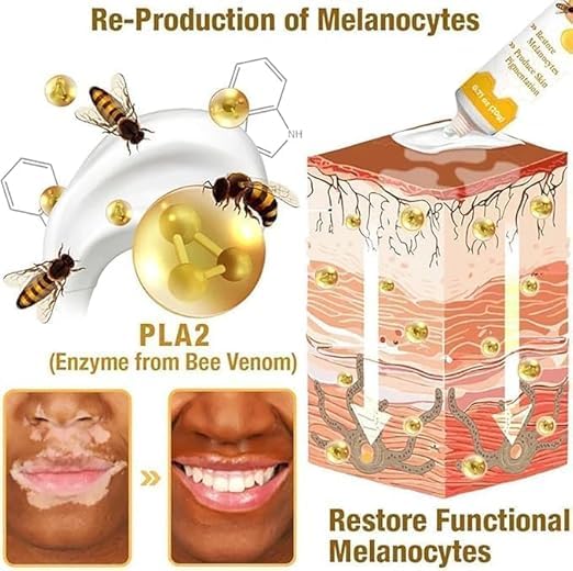 Bee Venom Vitiligo Treatment Herbal Skin Pigment Repair Cream