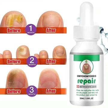 NAILS SERUM FOR NAIL GROWTH & REPAIR, FUNGAL INFECTION, ANTI-INFECTIVE REMOVAL PARONYCHIA ONYCHOMYCOSIS